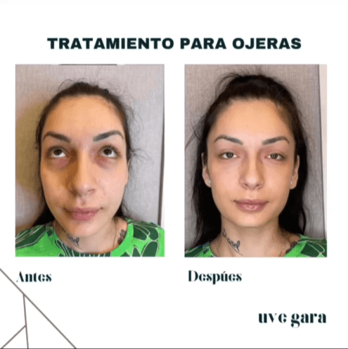 ojeras_paciente_1 ojeras_paciente_1