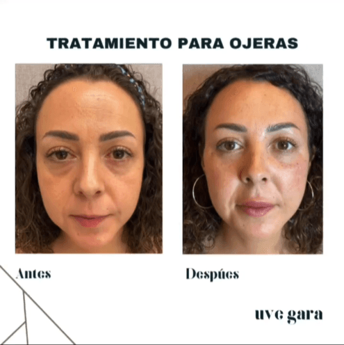 ojeras_paciente_2 ojeras_paciente_2