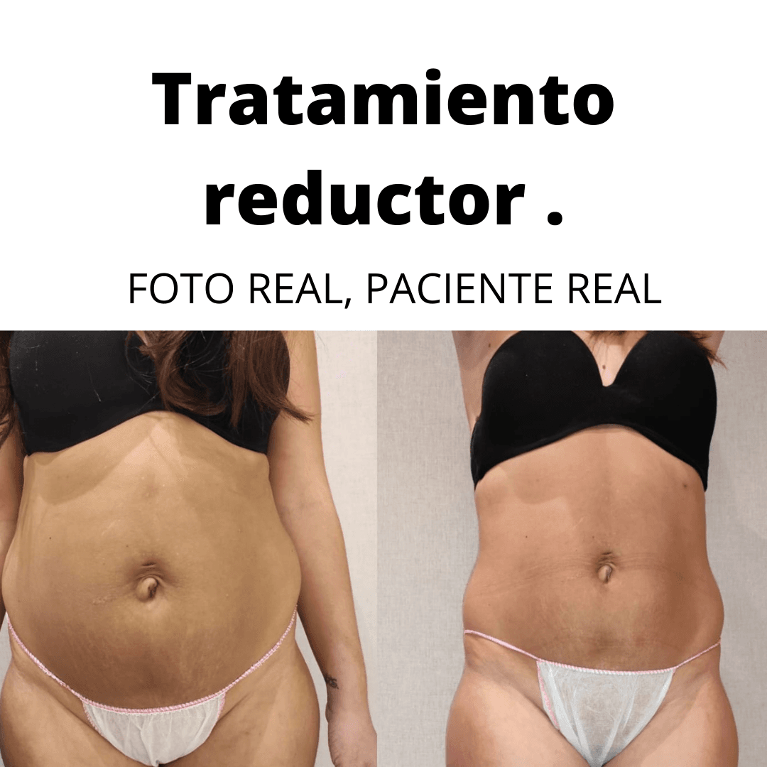 TRATAMIENTO REMODELADOR 8 SESIONES/ ZONA 1 TRATAMIENTO REMODELADOR 8 SESIONES/ ZONA