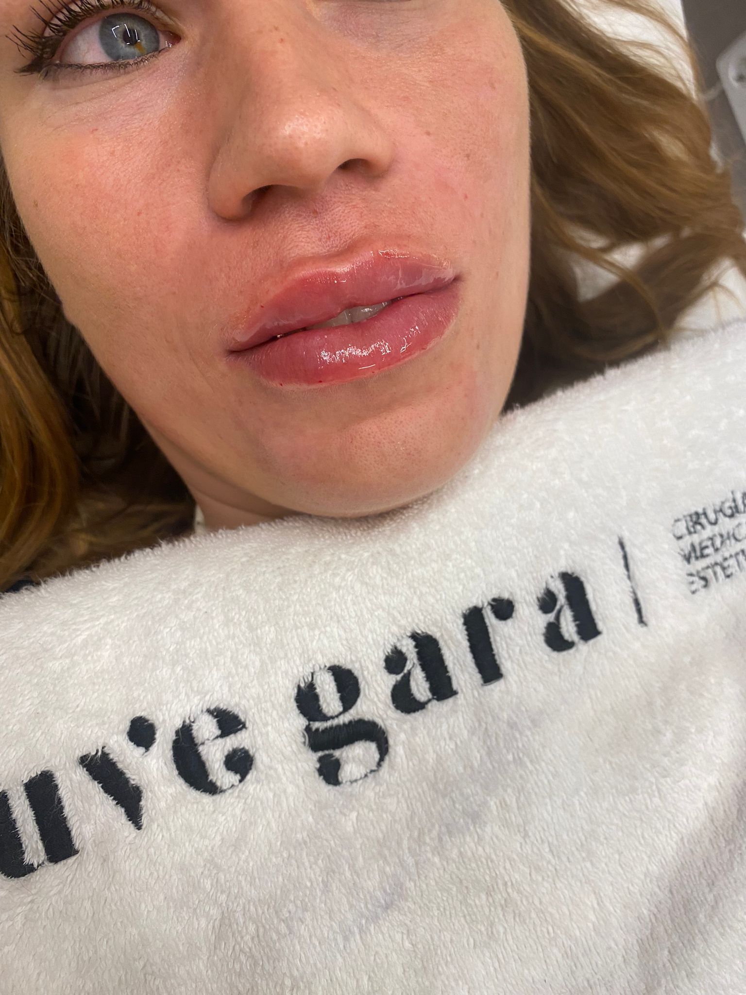 HIDRATACION LABIAL CON HIALURONICO 1 HIDRATACION LABIAL CON HIALURONICO