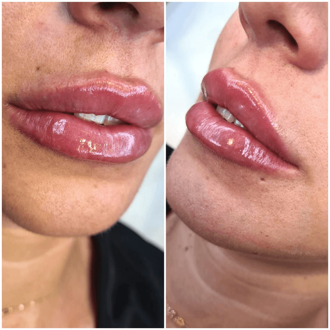 HIDRATACION LABIAL CON HIALURONICO 2 HIDRATACION LABIAL CON HIALURONICO - Imagen 2