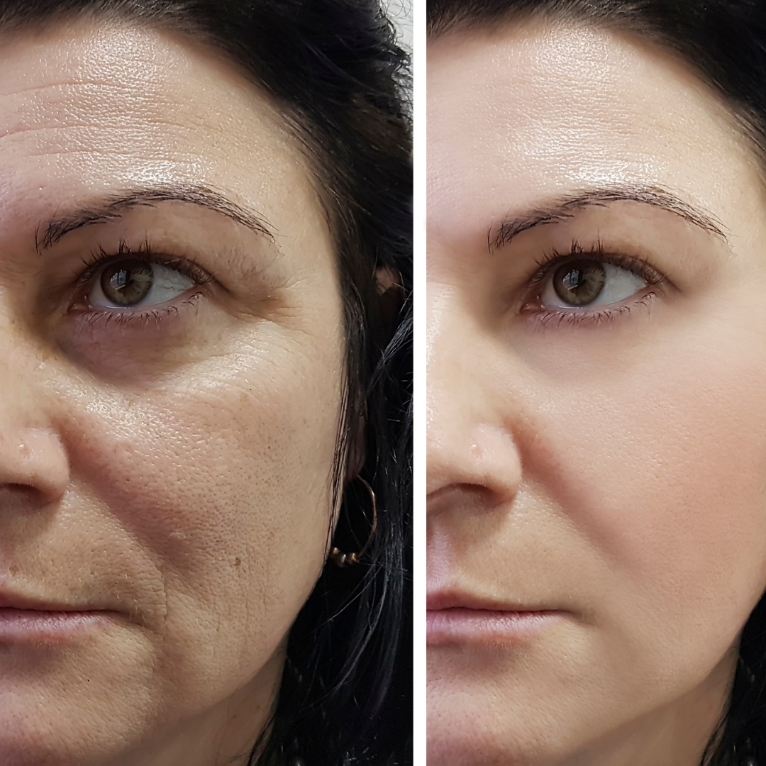 Antes Y Después Luz Pulsada Facial Precio Eliminar Manchas Ipl