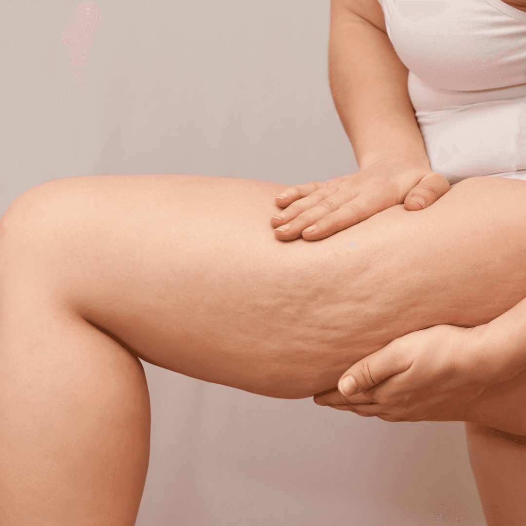 PACK ANTICELULITIS 12 SESIONES (6 sesiones de meso + 6 de aparatología reductora) 1 PACK ANTICELULITIS 12 SESIONES (6 sesiones de meso + 6 de aparatología reductora)