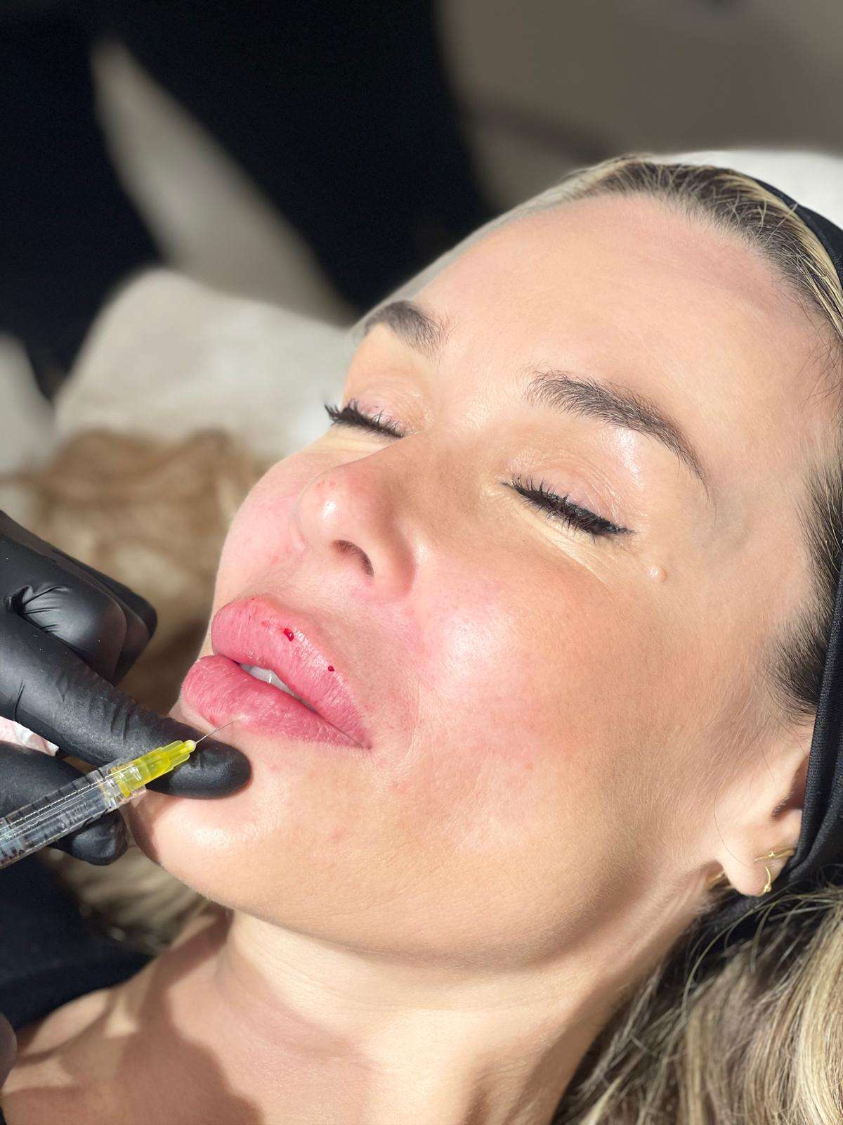 AUMENTO DE LABIOS 1 AUMENTO DE LABIOS