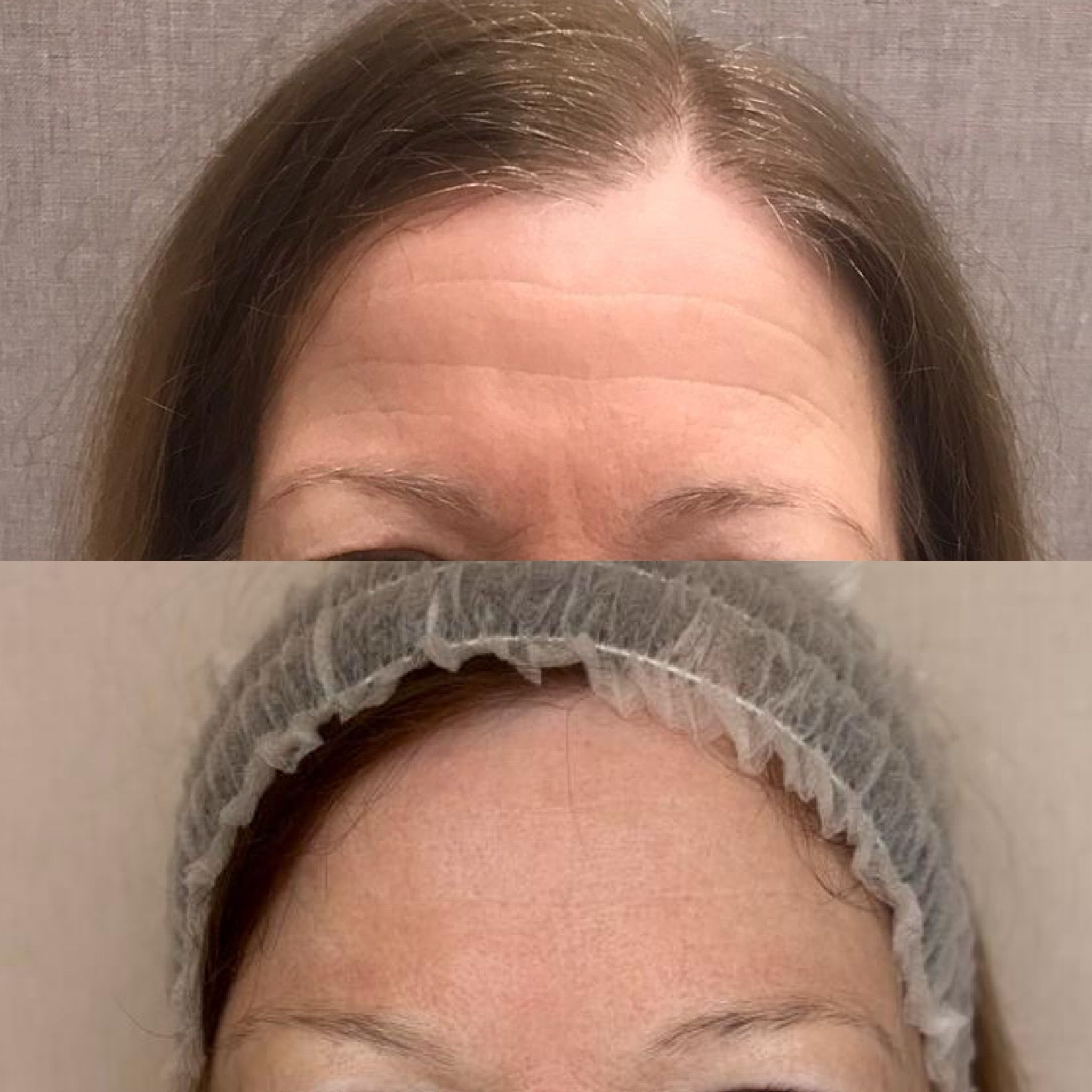 Tratamiento NEUROMODULADOR completo (frente, patas de gallo y entrecejo) 1 Tratamiento NEUROMODULADOR completo (frente, patas de gallo y entrecejo)