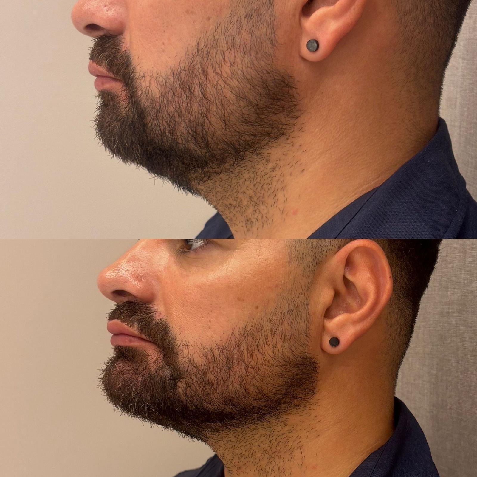 CAJA MAGICA-RADIESSE 3ML Bioestimulador facial 2 CAJA MAGICA-RADIESSE 3ML Bioestimulador facial - Imagen 2