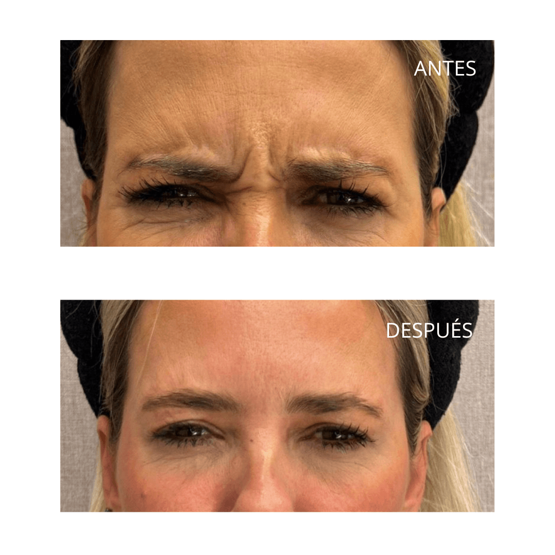 Tratamiento con neuromoduladores: la clave para un rostro joven y radiante 3 Entrecejo