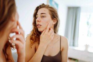 beautiful woman with acne problem skin checks dry 2025 03 09 01 39 56 utc min scaled