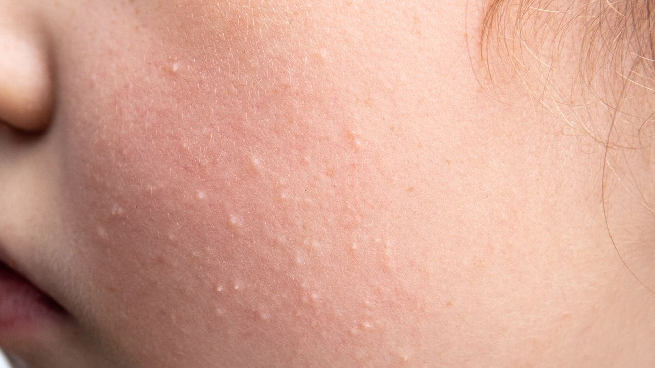 Miliums: ¿Qué son y cómo tratarlos? 1 persona con milium en la cara