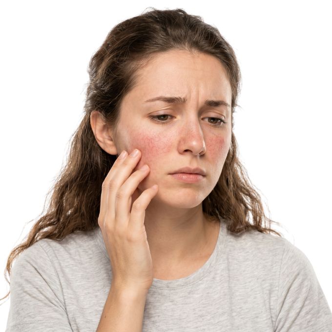 Precio del tratamiento de cuperosis Mujer con rojeces leves en el rostro antes del tratamiento para cuperosis facial