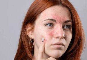 rosacea y cuperosis como el laser genesis pue destacada