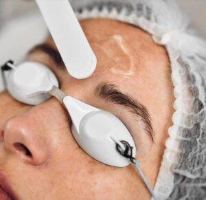 tratamiento melasma granada destacada