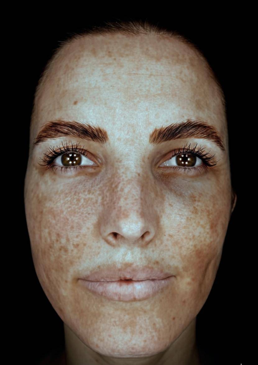 Tratamiento del melasma en Granada: ciencia, seguridad y resultados garantizados 2 tratamiento melasma granada gemini generated image 1pg0im1