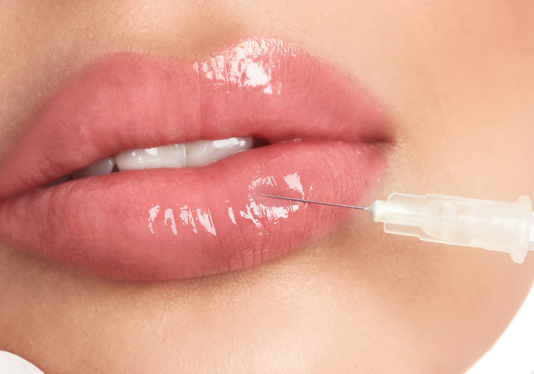 Procedimiento de aumento de labios en Granada Tratamiento para aumento de labios en Granada