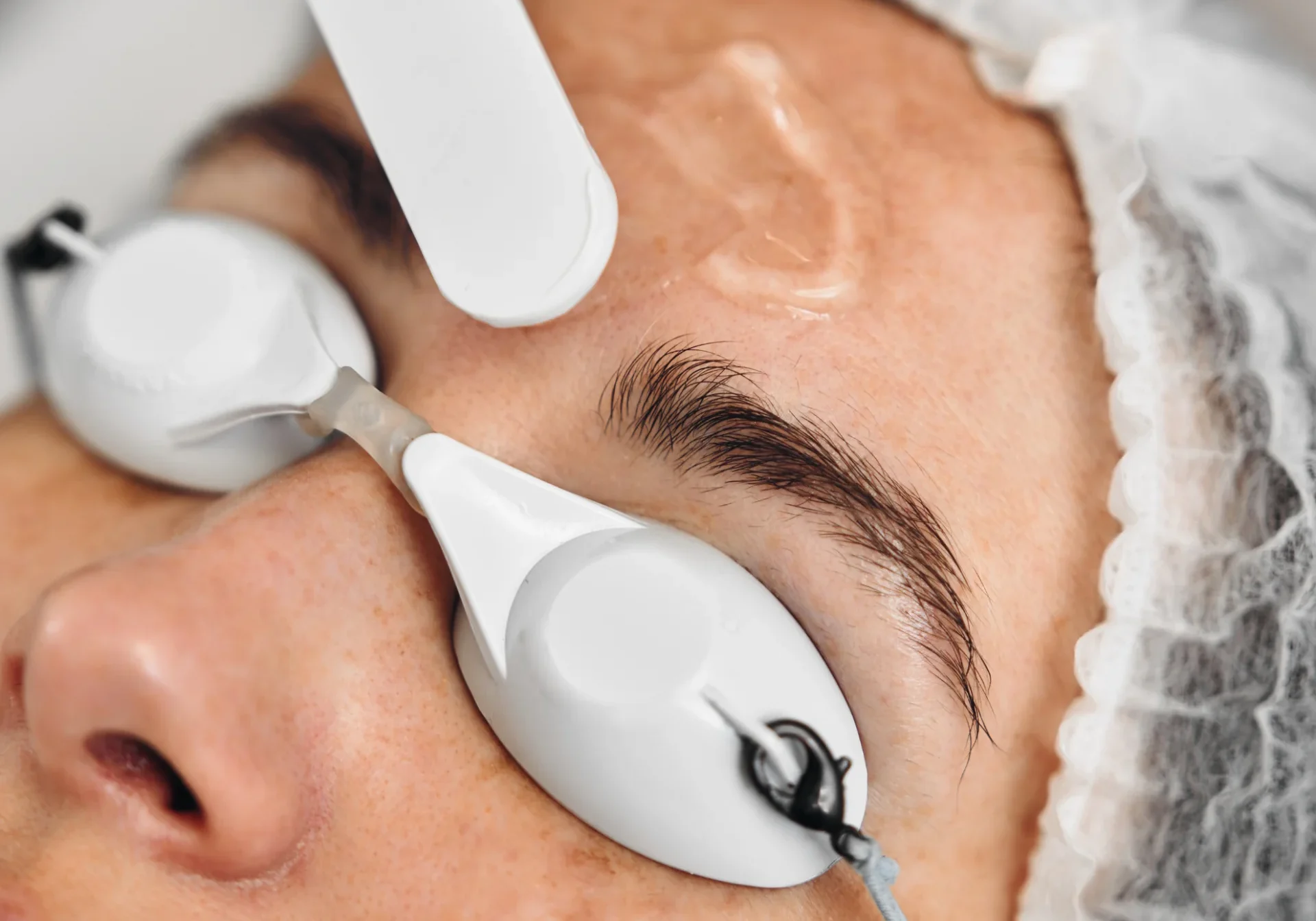 Fórmulas despigmentantes para manchas faciales Crema despigmentante tratamiento manchas cara