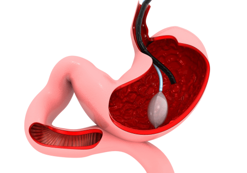 Cómo se coloca el balón gástrico y cuánto cuesta en Granada Procedimiento del balón gástrico y su precio en Granada