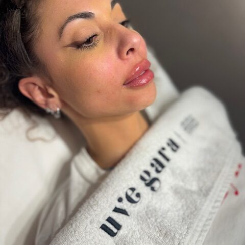 Proceso del ácido hialurónico para tratar el código de barras en Uvegara Detalles del cambio en los labios tras tratamiento en Uvegara