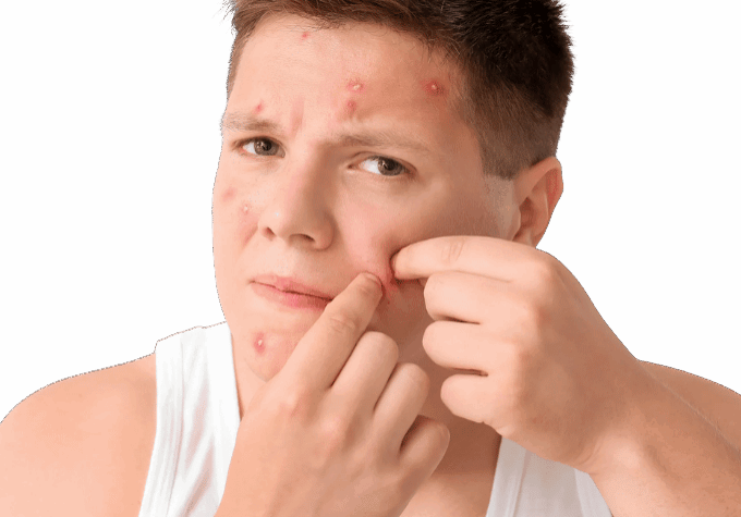 Marcas de acne y por que aparecen