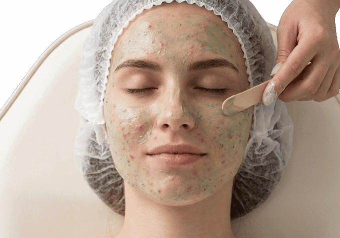 Tratamiento para marcas de acne