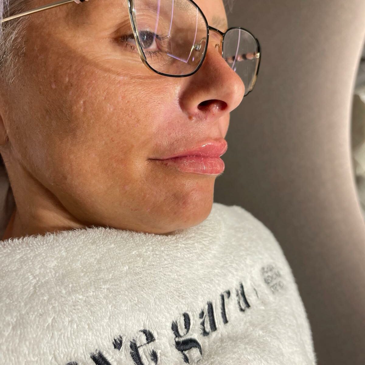 Transformación de labios en Uvegara Primer plano del resultado del aumento de labios en Uvegara