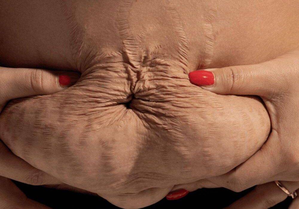 Abdominoplastia en Granada