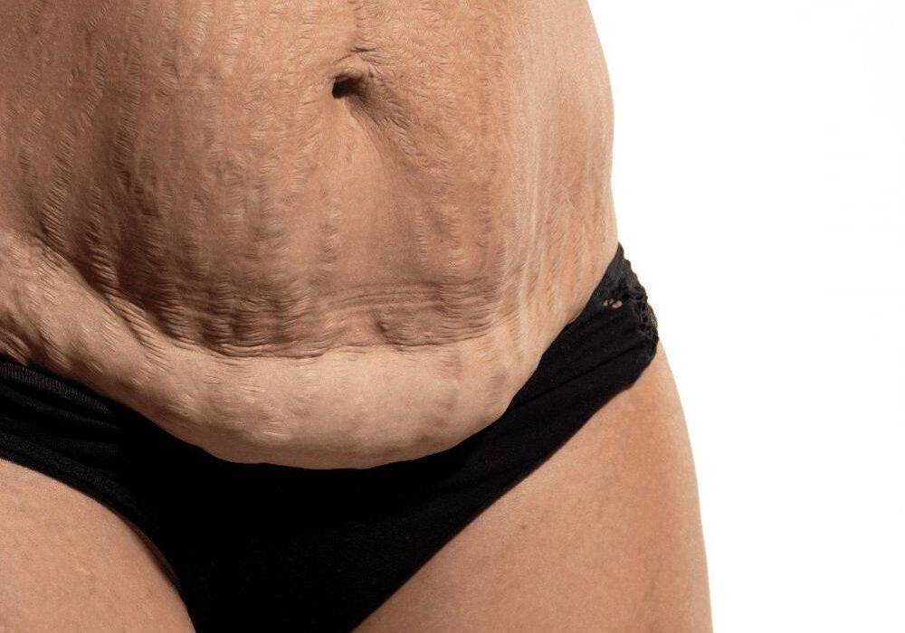 Abdominoplastia en Granada