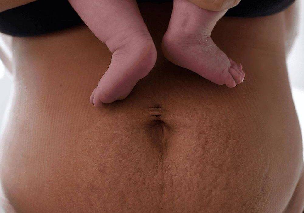 Abdominoplastia en Granada