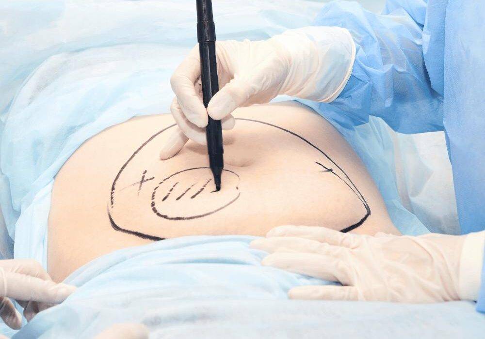 Liposucción: Remodela tu cuerpo y elimina la grasa