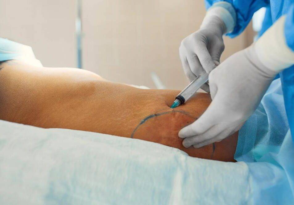 Liposucción: Remodela tu cuerpo y elimina la grasa
