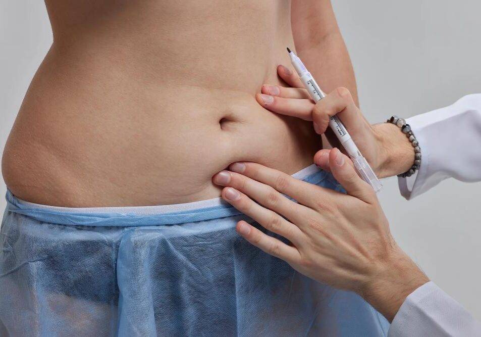 Liposucción: Remodela tu cuerpo y elimina la grasa